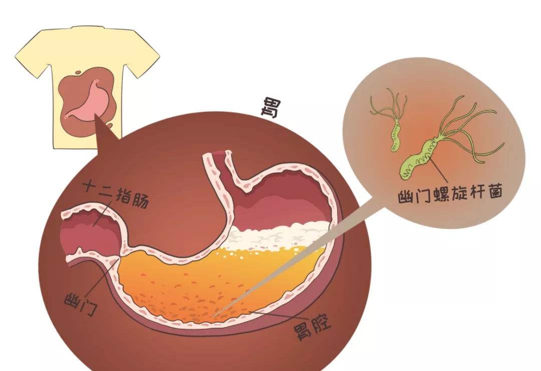 口臭的幽门螺杆菌生长范围