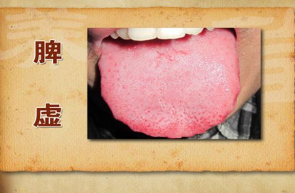 脾气虚湿热口臭的原因及治疗方法
