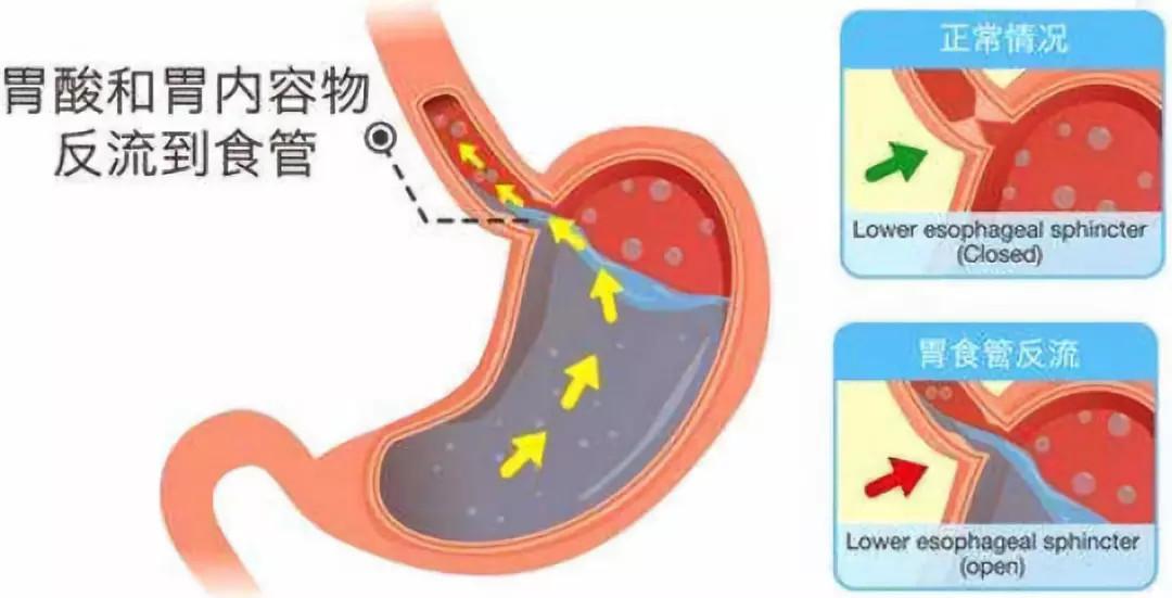 反流性食管炎示意图