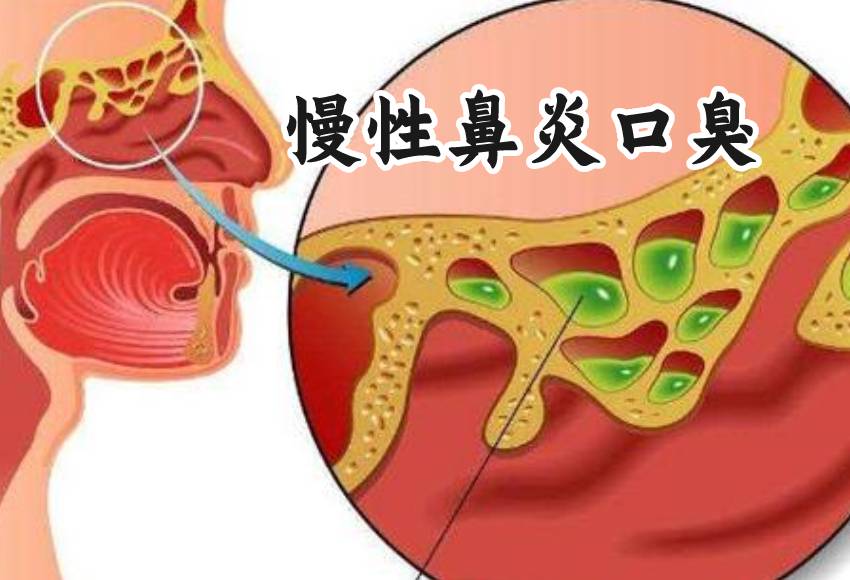鼻炎示意图