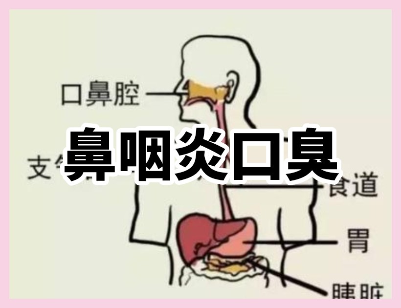 鼻咽炎口臭示意图