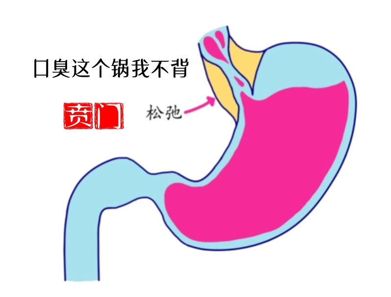 贲门松弛示意图