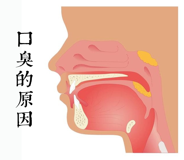 口臭者的图像