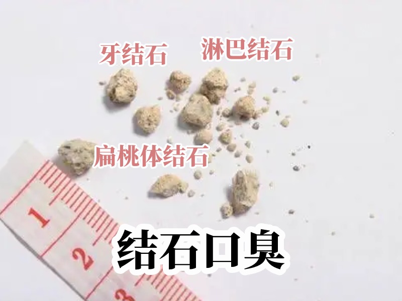 结石口臭示意图