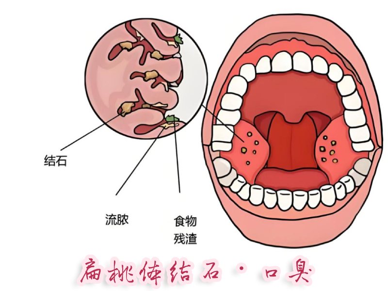 扁桃体结石与口臭